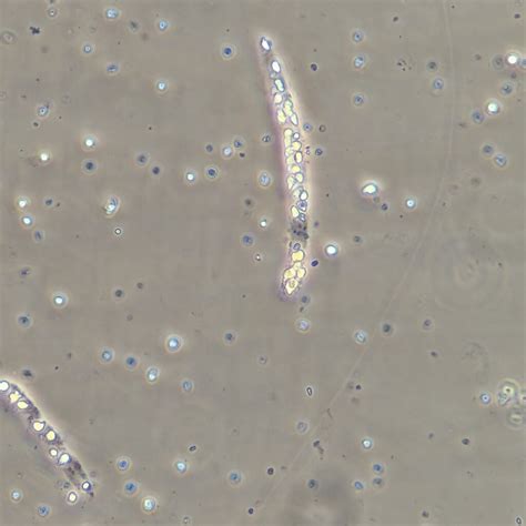 White Blood Cell Casts: Identification & Significance - MedLabBuddy