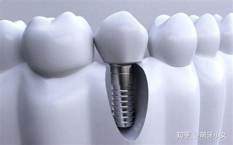 专家解读：牙齿矫正会导致牙齿松动吗？_健康_腾讯网