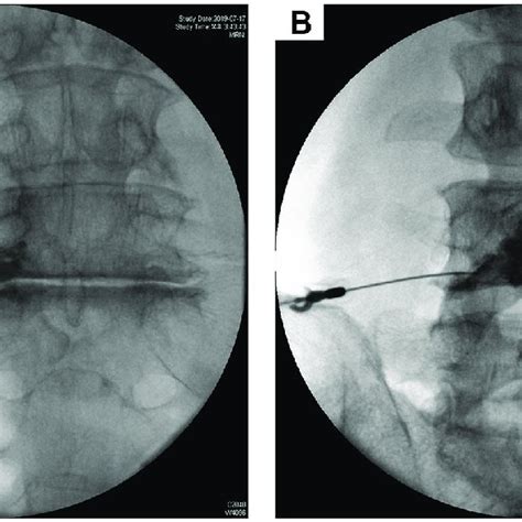 Image result for Selective Nerve Root Block Contrast Spread Pattern