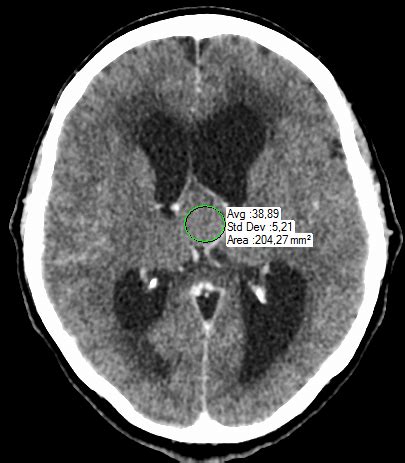 Image result for Scanner Cerebral Avec Injection Diode