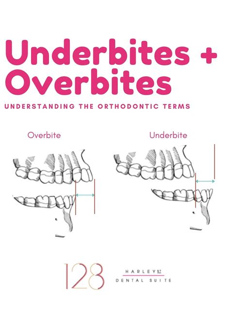 How to fix an underbite | 128 Harley Street Dental