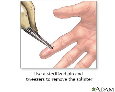Image result for Infected Splinter Removal
