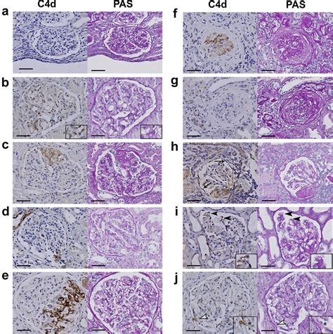 Glomerular C4d deposition can precede the development of focal segmental glomerulosclerosis ...