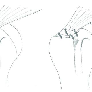 Image result for Single Row Rotator Cuff Repair