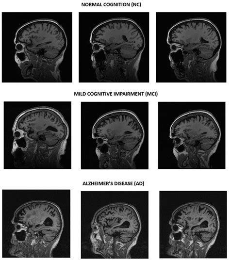 Alzheimer’s Multiclassification Using Explainable AI Techniques