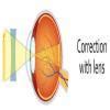 Name a defect of an eye which is known as Near-sightedness and how it ...