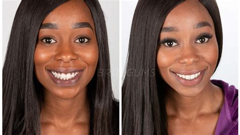 Can I Remove Purple Spots on My Gums?