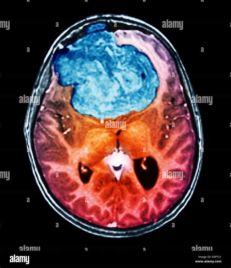 Benign brain tumour. Coloured computed tomography (CT) scan of the ...