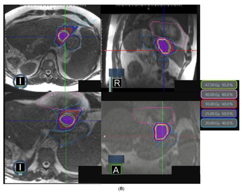 Stereotactic MR-Guided Radiotherapy for Liver Metastases: First Results ...