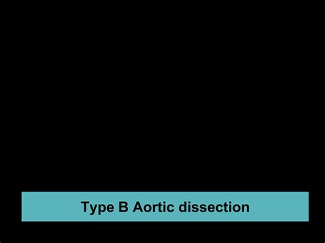Type B AORTIC DISSECTION | PPTX