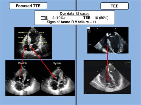 PPT - Amniotic fluid embolism General view, multicenter survey and ...
