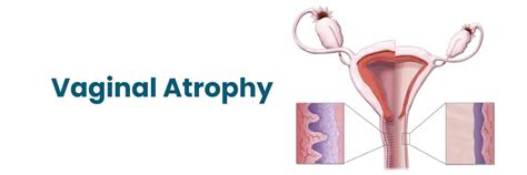 Vaginal Atrophy: Causes and Treatments | Medicover Hospitals