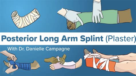 Posterior Elbow Splint