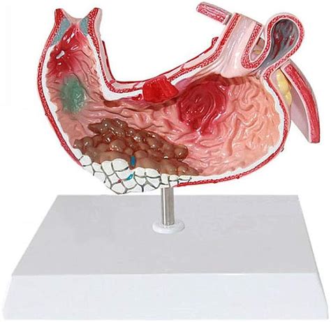Yuanzhou Demonstration Model Of Gastric Lesions Stomach Anatomy ...