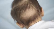 Infants Lose Hair by Hair Loss In Babies Babycenter Infants Lose Hair