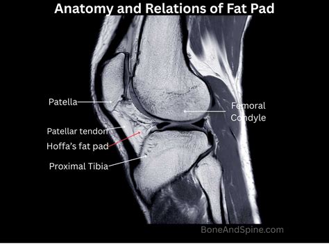 Hoffa Syndrome: Causes, Diagnosis & Management | Bone and Spine