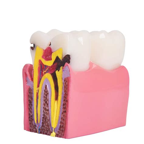 Buy ANNWAH Dental Caries Teeth Model,Dental Anatomy Education Tooth ...