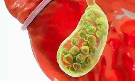 Isolated CBD Dilation on Ultrasound Not Linked to Increased ...