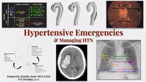 Hypertensive emergencies | PPTX