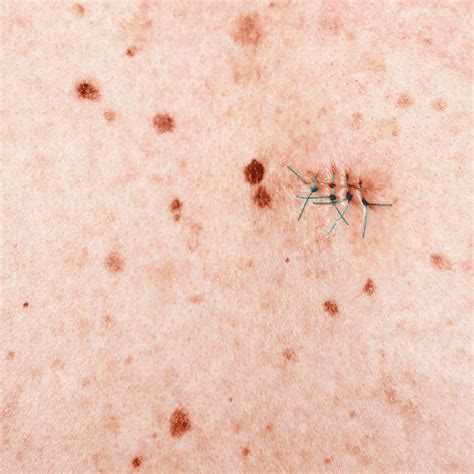 Procedures and surgery - Melanoma Focus