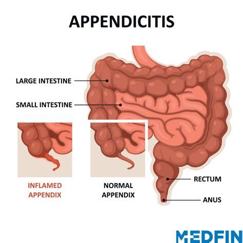 Image result for Appendicitis Position