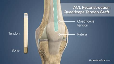 Torn ACL Reconstruction (Quadriceps Graft) – UnderstandOrtho™