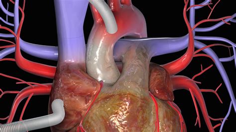 Hjärtkirurgi - olika kirurgiska behandlingar av hjärtat