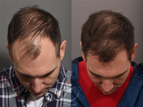 Male FUE Hair Transplant Before & After Photo Gallery | Serving Rochester, Syracuse & Buffalo ...
