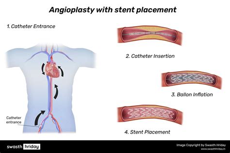 What Is Angioplasty? | A Minimally Invasive Solution for Blocked Arteries