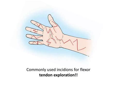 Flexor tendon injuries.m | PPTX