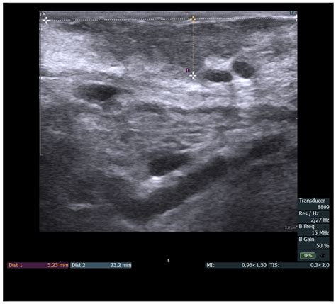 Intraoral Ultrasound versus MRI for Depth of Invasion Measurement in Oral Tongue Squamous Cell ...