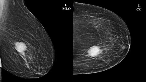 Papiloma intraductal mamario: síntomas, causas, diagnóstico y tratamiento