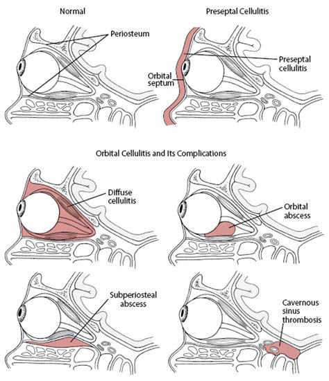 Preseptal and Orbital Cellulitis - Preseptal and Orbital Cellulitis ...
