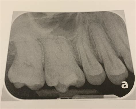 Intermittent Tooth/Jaw Pain - RCT : r/askdentists