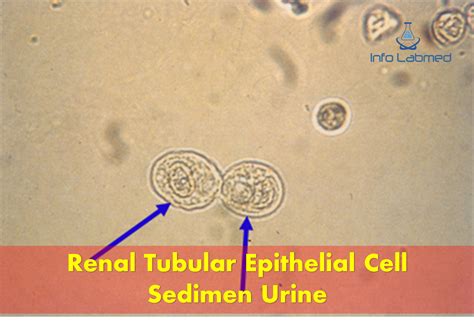 Epithelial Cells In Urine