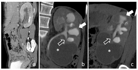 CT Urography Findings of Upper Urinary Tract Carcinoma and Its Mimickers: A Pictorial Review