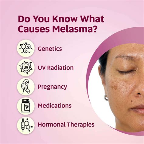 Buy Melasma Treatment Cream for Face