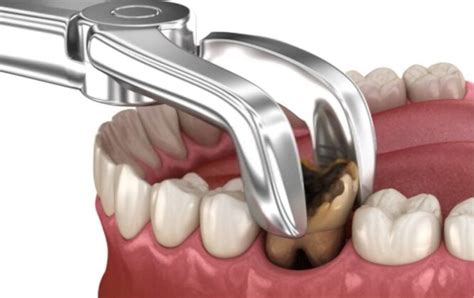 Image result for Pulled Tooth