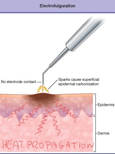 Implicaciones económicas de los ajustes de arco en función de la temperatura