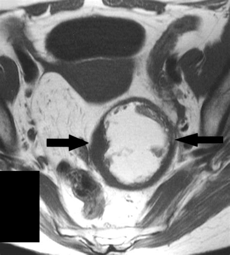 Characterization of Adnexal Mass Lesions on MR Imaging | AJR