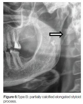 Image result for Styloid Process of Temporal Bone X-ray Positioning
