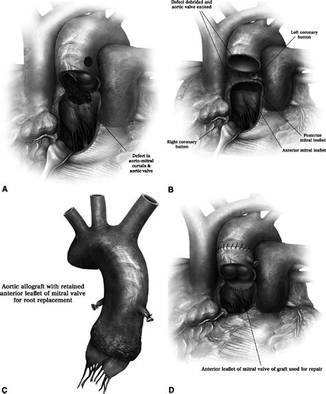 Image result for Devitalized Tissue Example