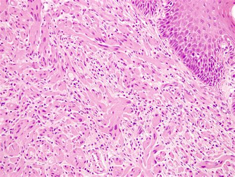 Pathology Outlines - Granular cell tumor