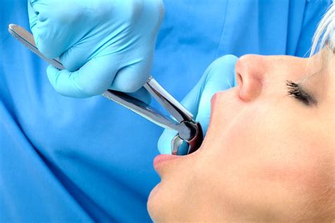 Image result for Tooth Extraction HD Images