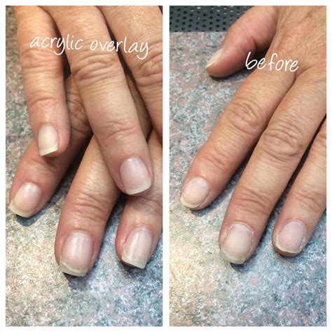 Before and after acrylic overlay full set | Spring acrylic nails ...
