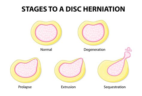 Can Disc Herniations Heal? | Apex