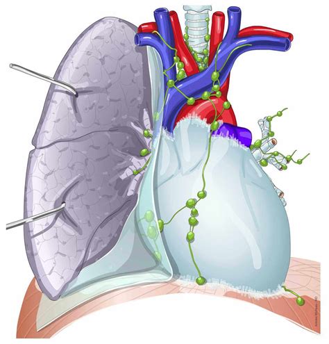 Mediastinal Lymph Nodes