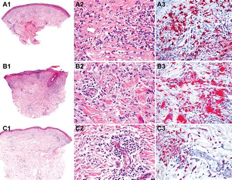 Acrodermatitis Chronica Atrophicans