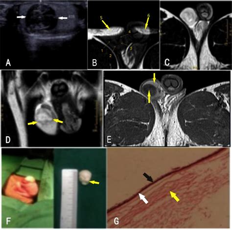Imaging in testicular epidermoid cysts - Clinical Imaging