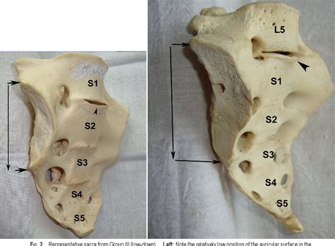 Auricular Surface Of Ilium